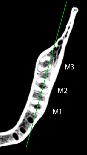 mand molar root alignment